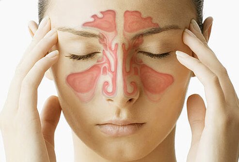 季節の変わり目でアレルギーから副鼻腔炎で辛い状態に。（緩和するためのセルフケア継続中）